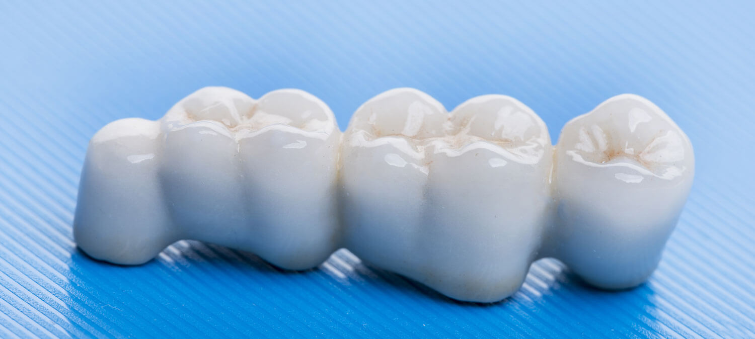 What Are Dental Bridges?