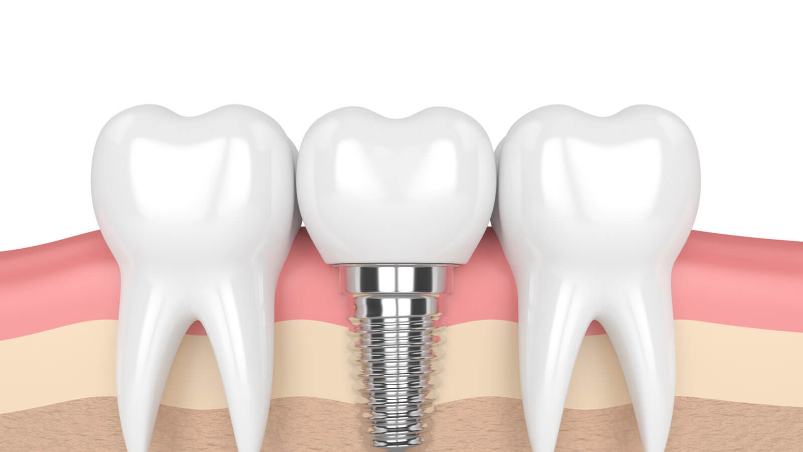 DENTAL IMPLANTS