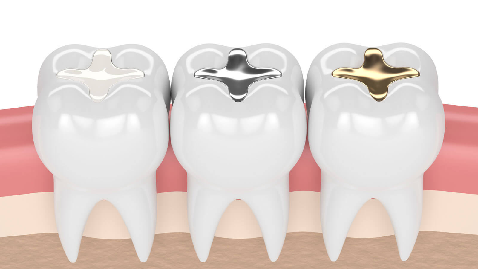 How Does Our Fillings Service Work?