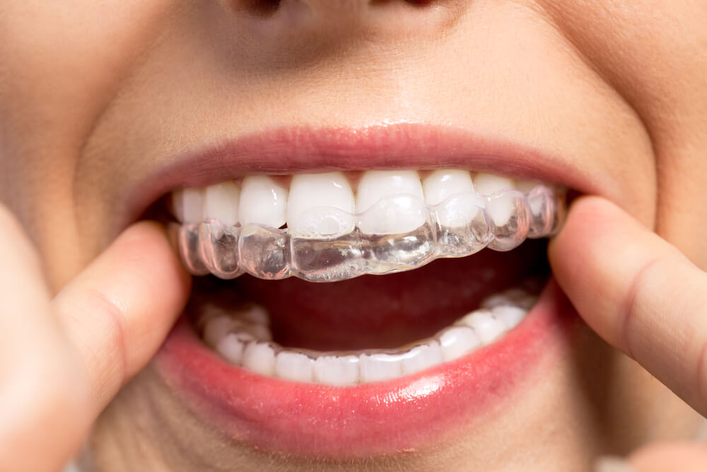 What is Short Term Orthodontics?